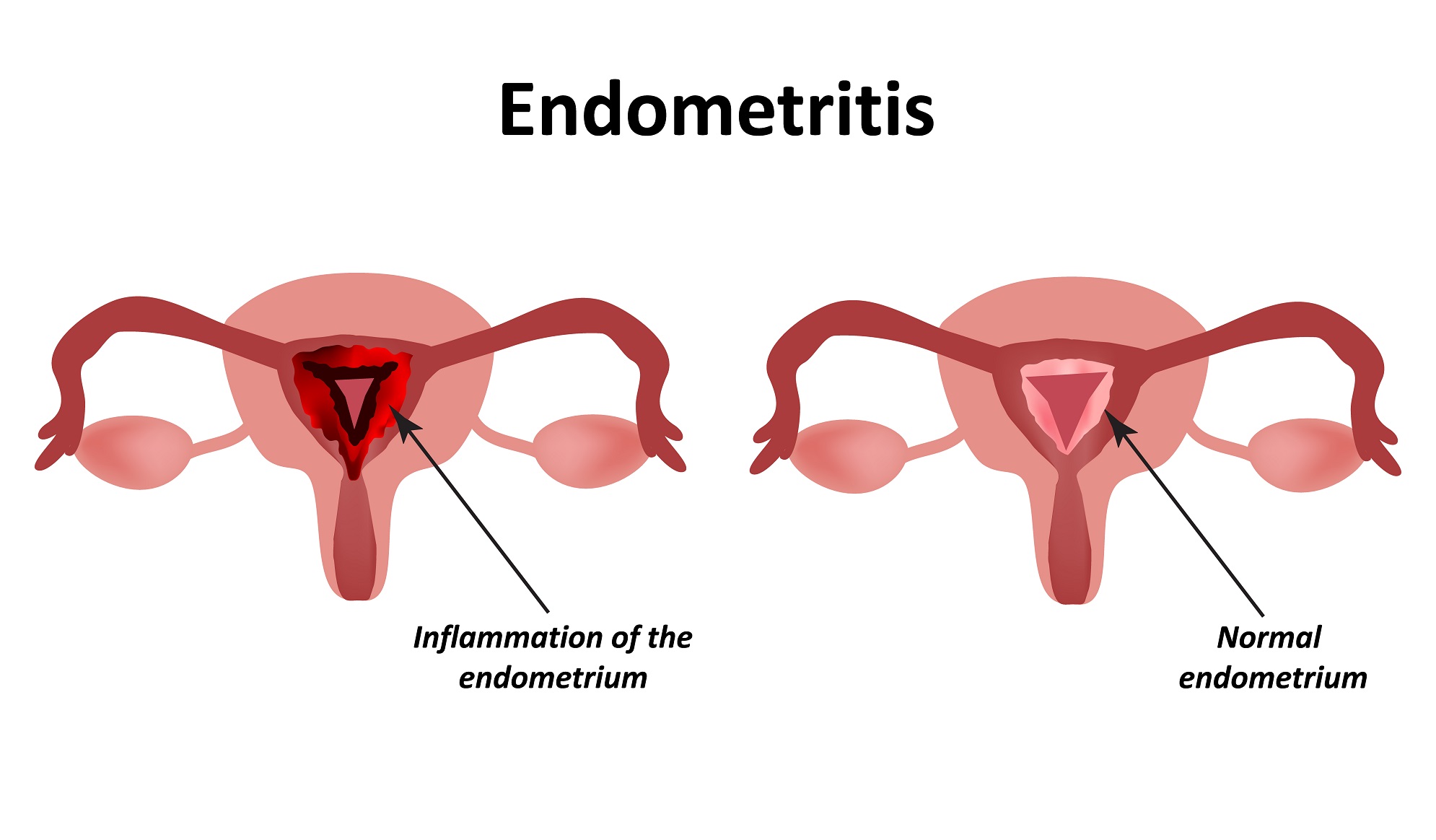 endomteritis treatment endomteritis teatment