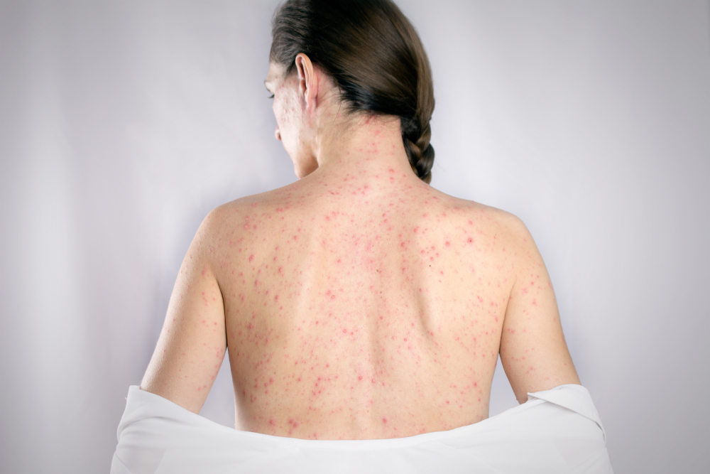 German measles in pregnancy German measles in pregnancy