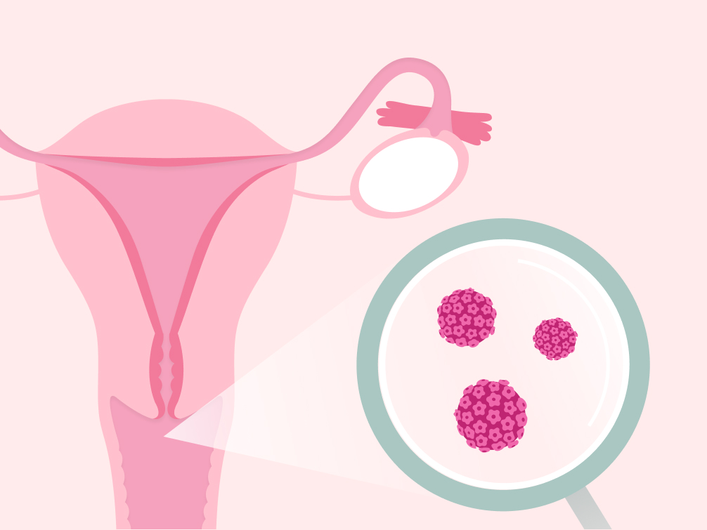 magnified abnormal pap smear cells magnified abnormal pap smear cells