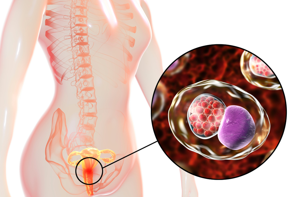 The depiction of chlamydia infection The depiction of chlamydia infection