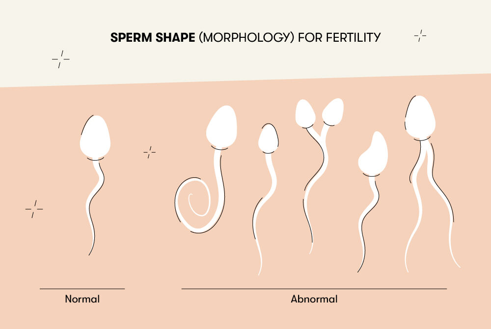 A typical sperm has an oval head and a long tail, whereas features like a bent tail, dual tails, or misshapen heads indicate abnormal sperm.