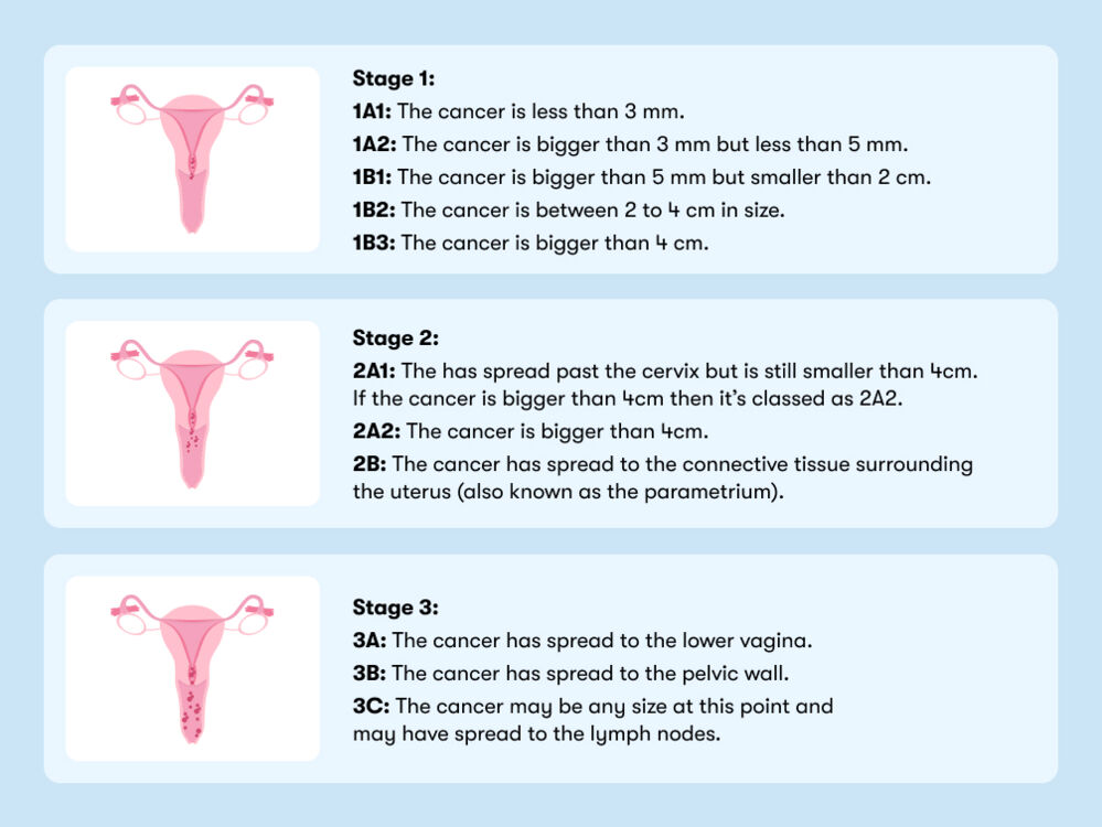 An infographic displaying three stages and subdivisions of cervical cancer, each further divided into specific locations and measurement criteria.