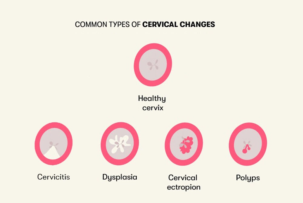 Common types of cervical changes