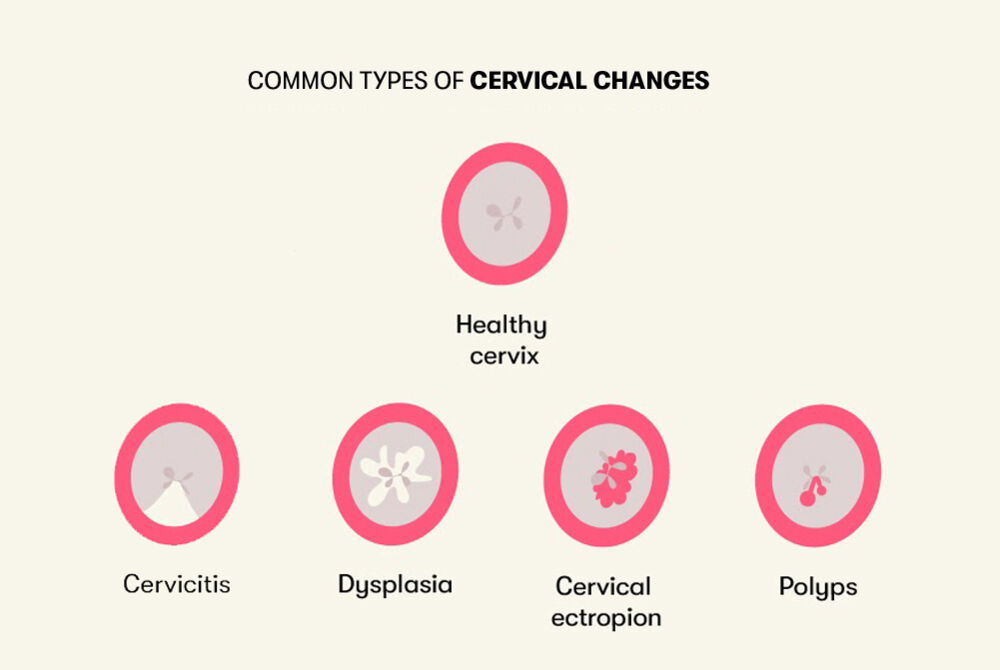 Different abnormalities affecting the cervix, distinct from a healthy state, encompass cervicitis, dysplasia, cervical ectropion, and polyps.