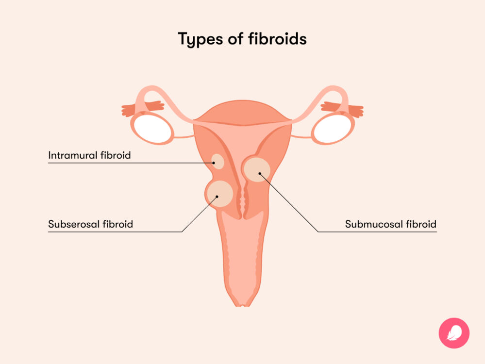 The most common types of fibroids are intramural fibroids grow in the uterus muscle wall, subserosal fibroids grow in the outer uterus and submucosal fibroids grows in the muscle layer beneath the inner lining of the uterus