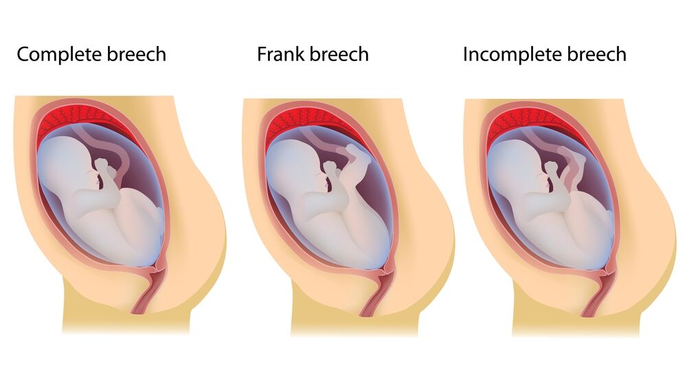 Breech baby positions