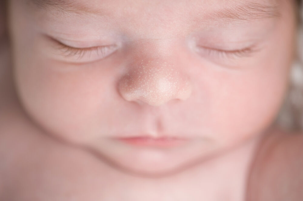 Milia on a newborn's face