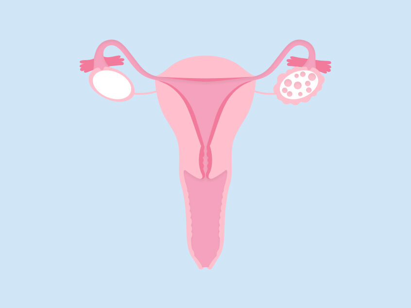 SOPK et endométriose : le SOPK à l’intérieur du système reproducteur féminin