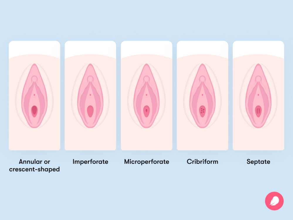 different types of hymen and what they can look like