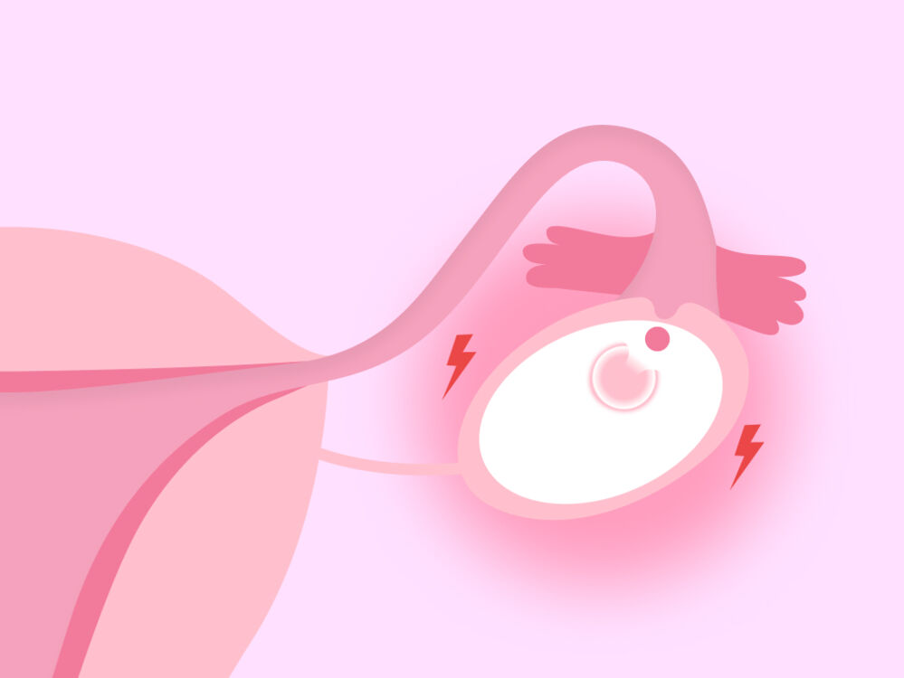 Ovulation pain - ovaries releasing egg