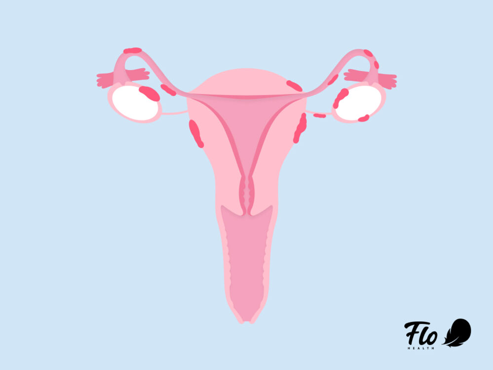 Endometriosis inside female reproductive system
