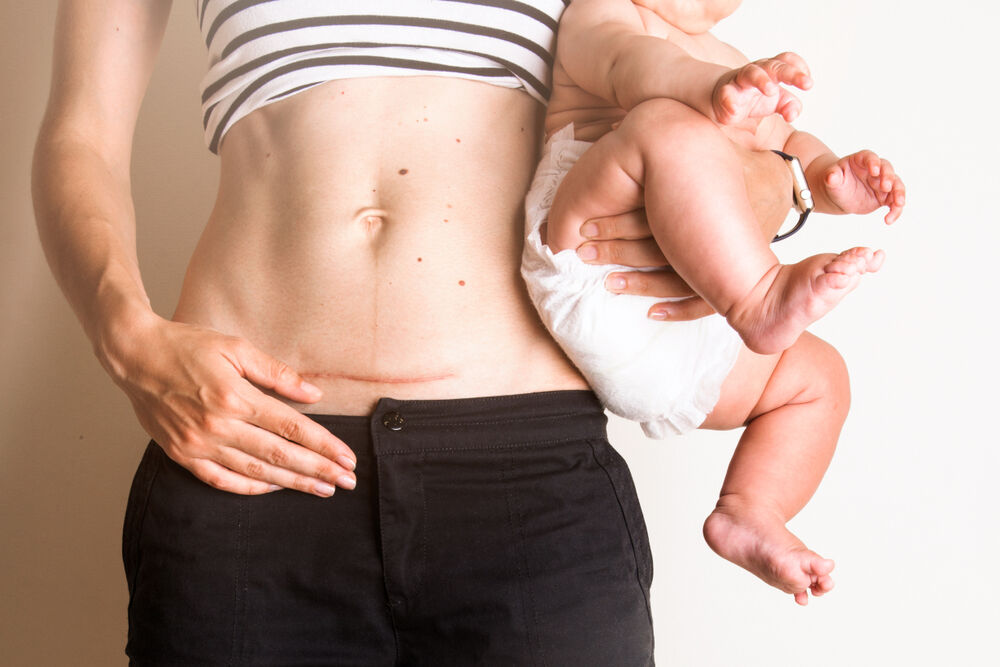 woman with a baby showing her scar after a c-section delivery