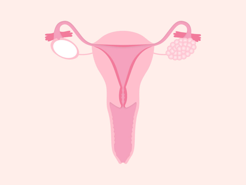 Ovarian cancer bloating