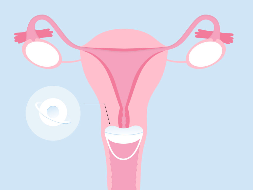 Sponge Contraceptive Insertion