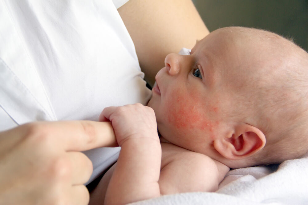 Red blotches on the face of a newborn