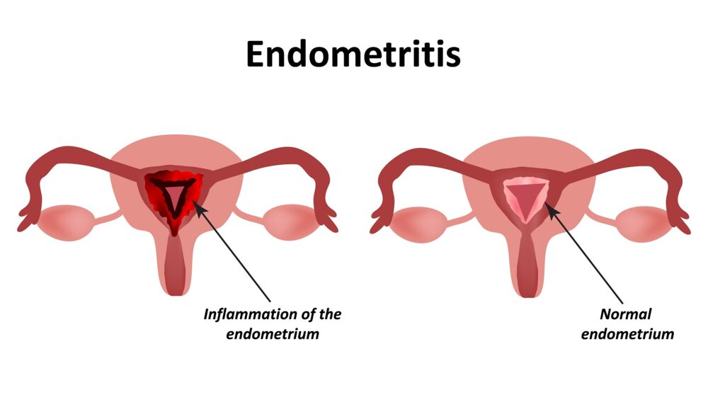 An inflamed endometrium signifies endometritis, often linked to postpartum retention of fetal tissues after childbirth, miscarriage, abortion, or intrauterine device usage.
