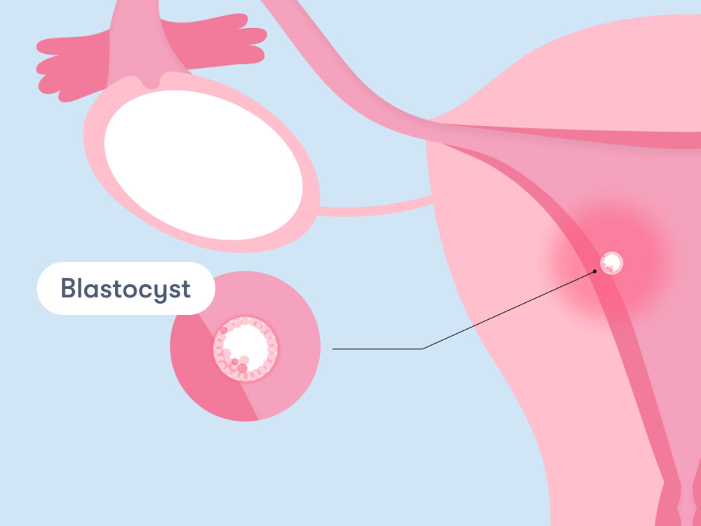 One of the reasons why women might experience implantation cramps is that blastocyst needs to attach to the uterus wall in order to begin receiving nutrients.