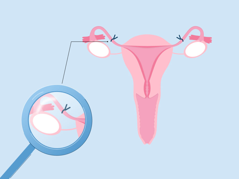 Non hormonal birth control - sterilization