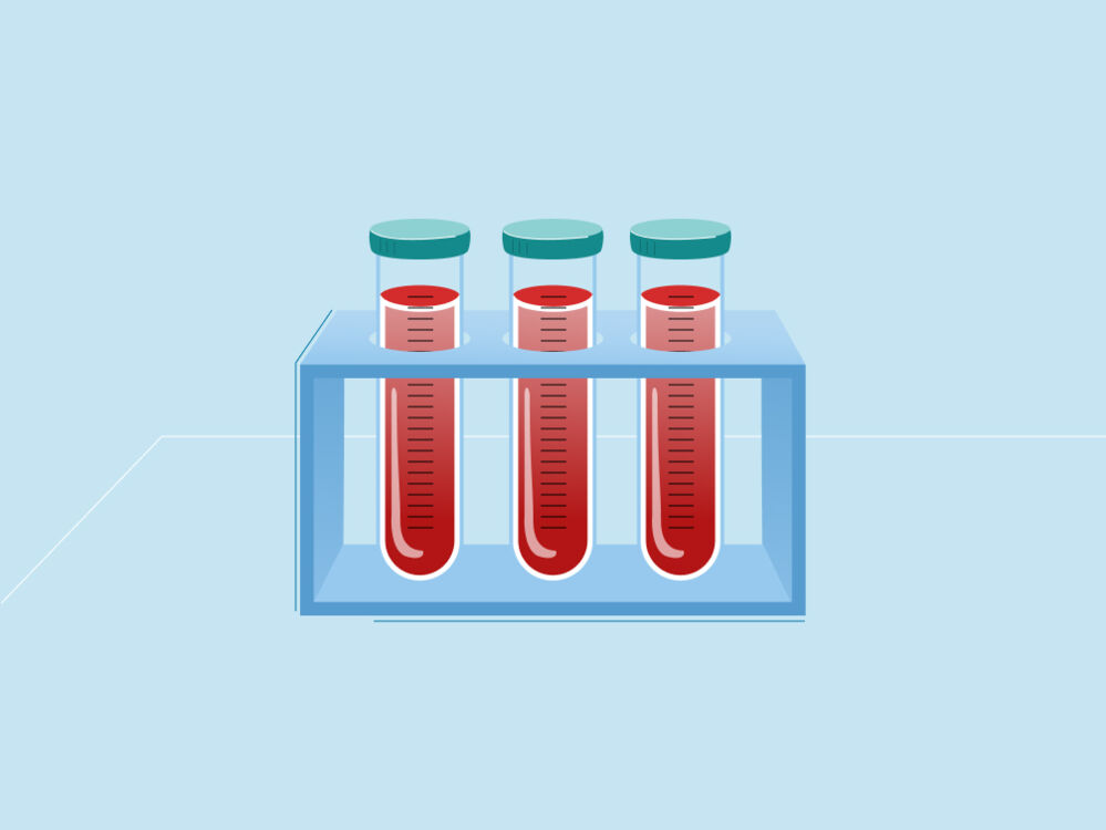 Gestational diabetes - blood test sample