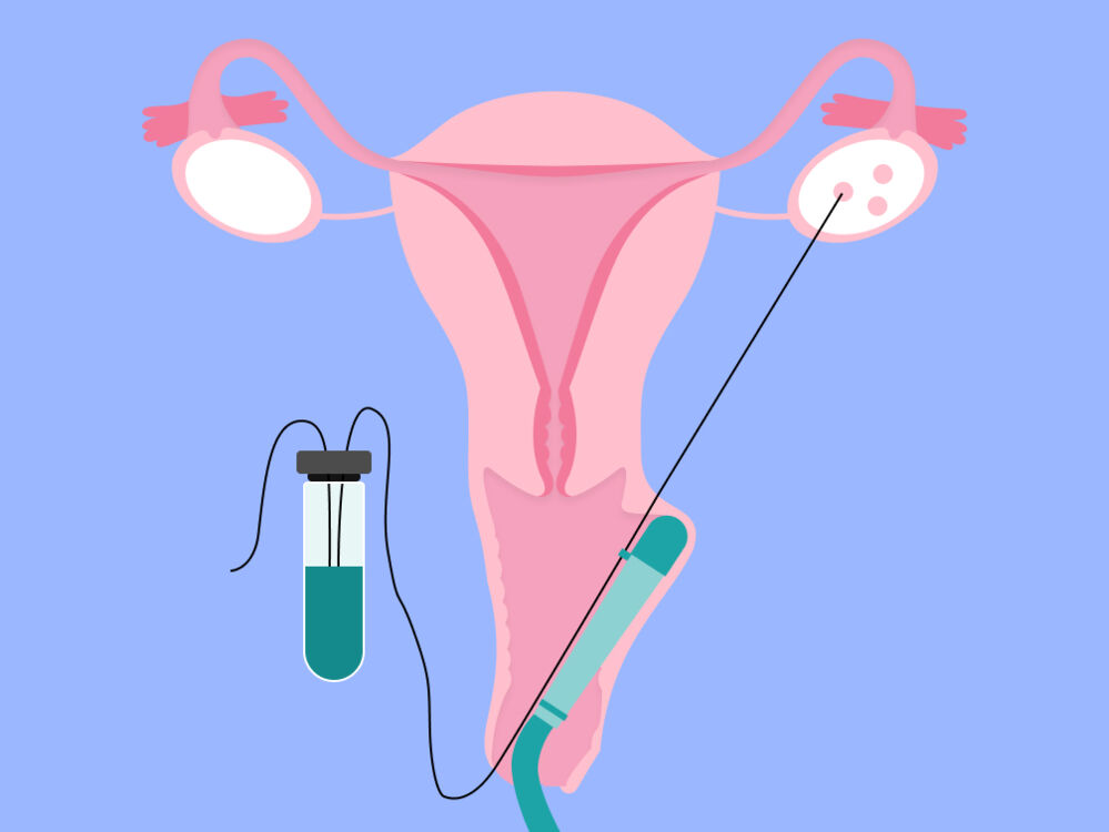 IVF egg retrieval process