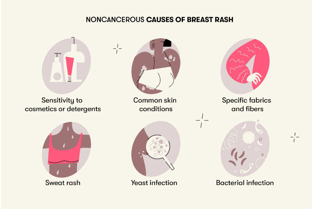under breast fungal rash