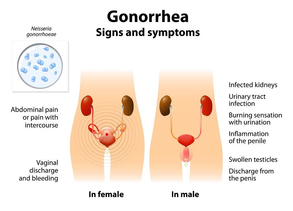 cervix with gonorrhea