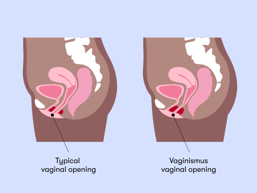 Typical Vaginal Opening vs Vaginismus
