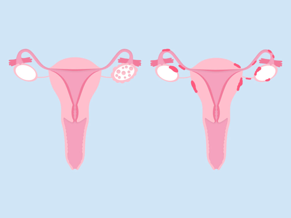 SOP vs endometriose