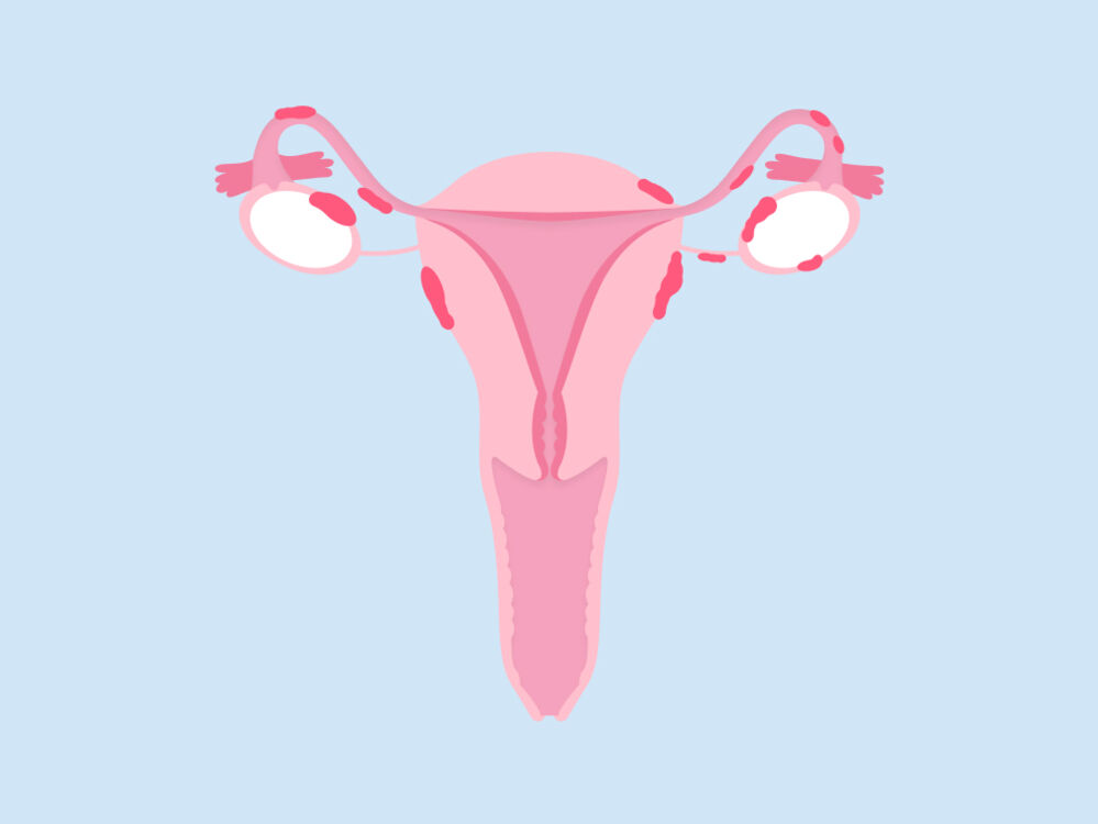 Endometriose: weibliches Fortpflanzungssystem