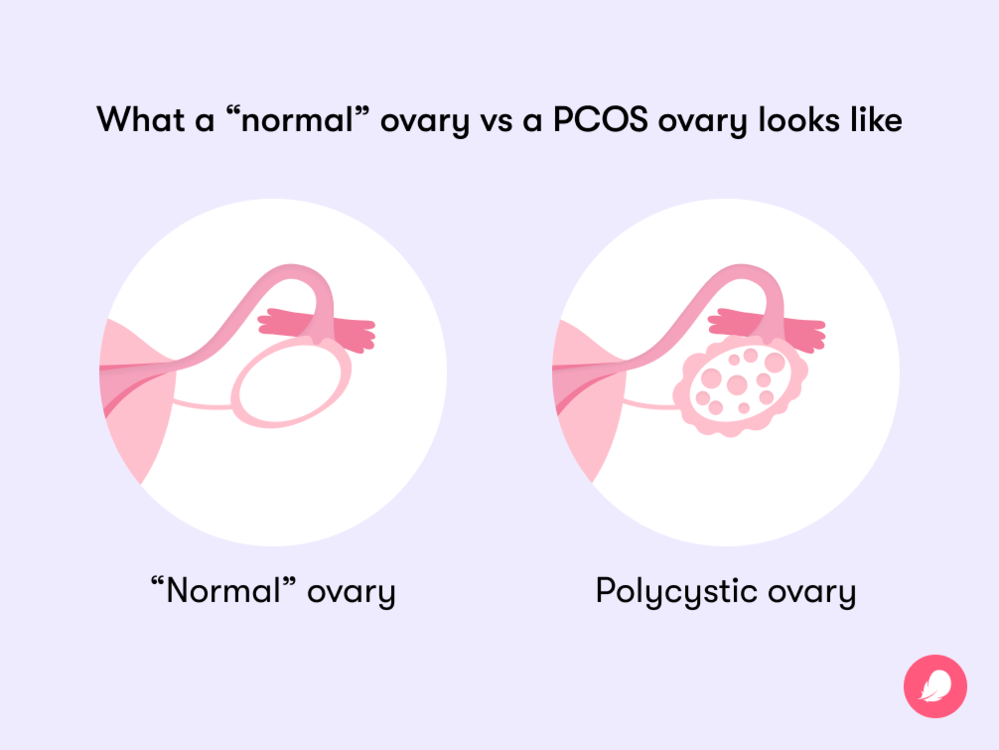 A PCOS ovary vs a normal ovary