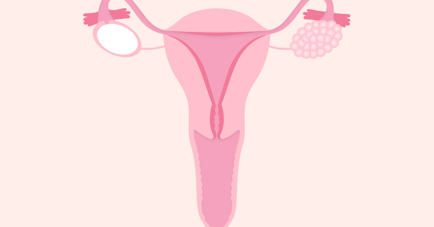 How is ovarian cancer detected?