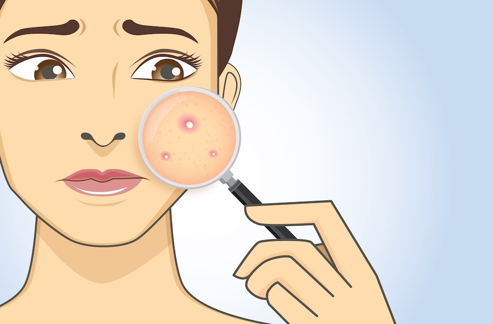 A magnifier on hand magnifying the woman facial to finding acne A magnifier on hand magnifying the woman facial to finding acne