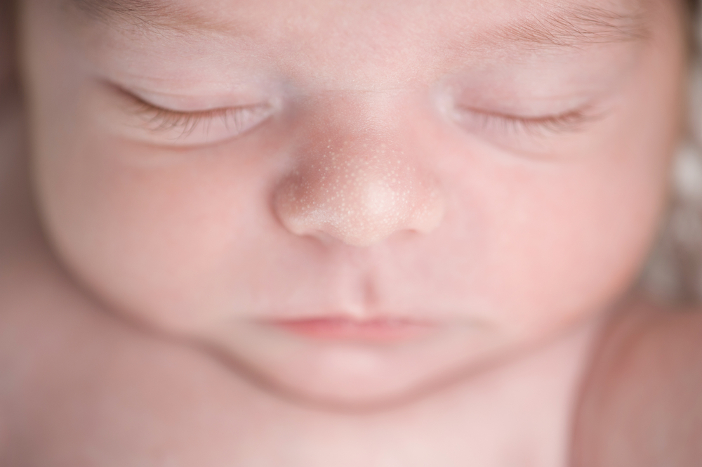 Milia on a newborn's face Milia on a newborn's face