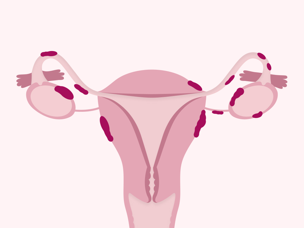 What Is Endometriosis – and What Are My Options?