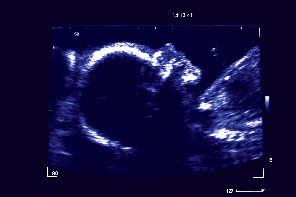 A scan of an ultrasound image of a 26 week old fetus