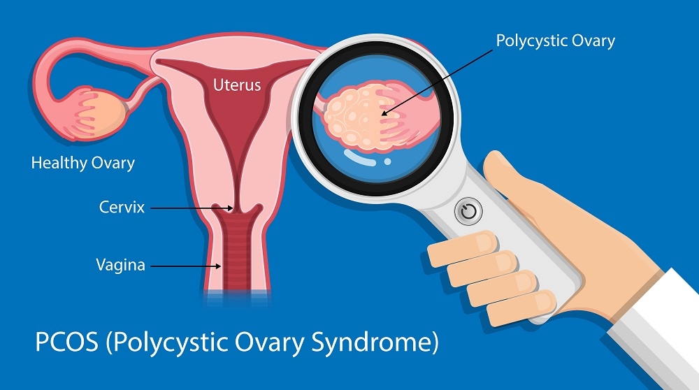 PCOS diagnosis PCOS diagnosis