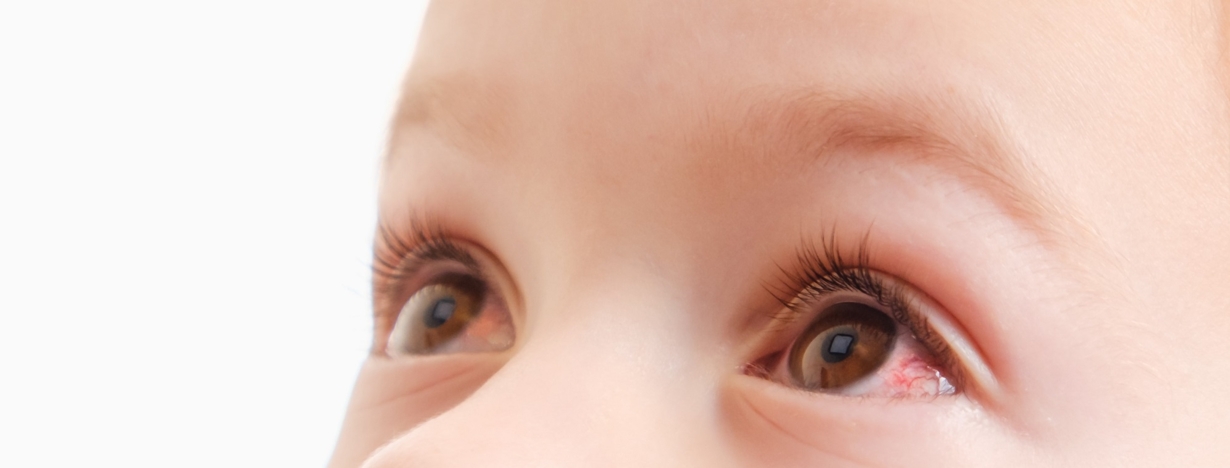 Treatment For Conjunctivitis In 1 Year Old