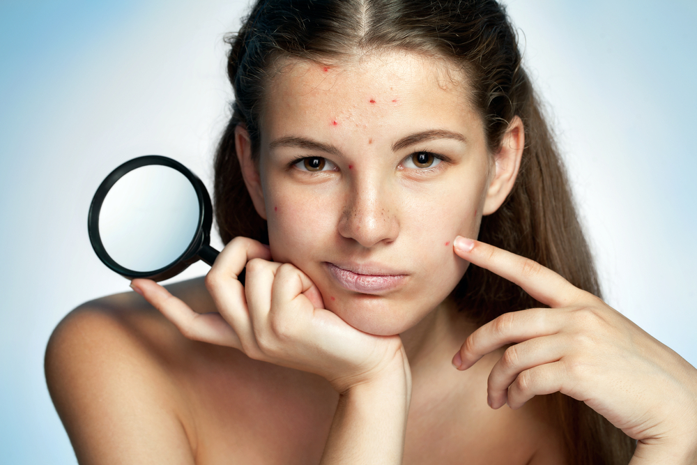 Teenage girl with acne - one of the signs of puberty in girls Teenage girl with acne - one of the signs of puberty in girls