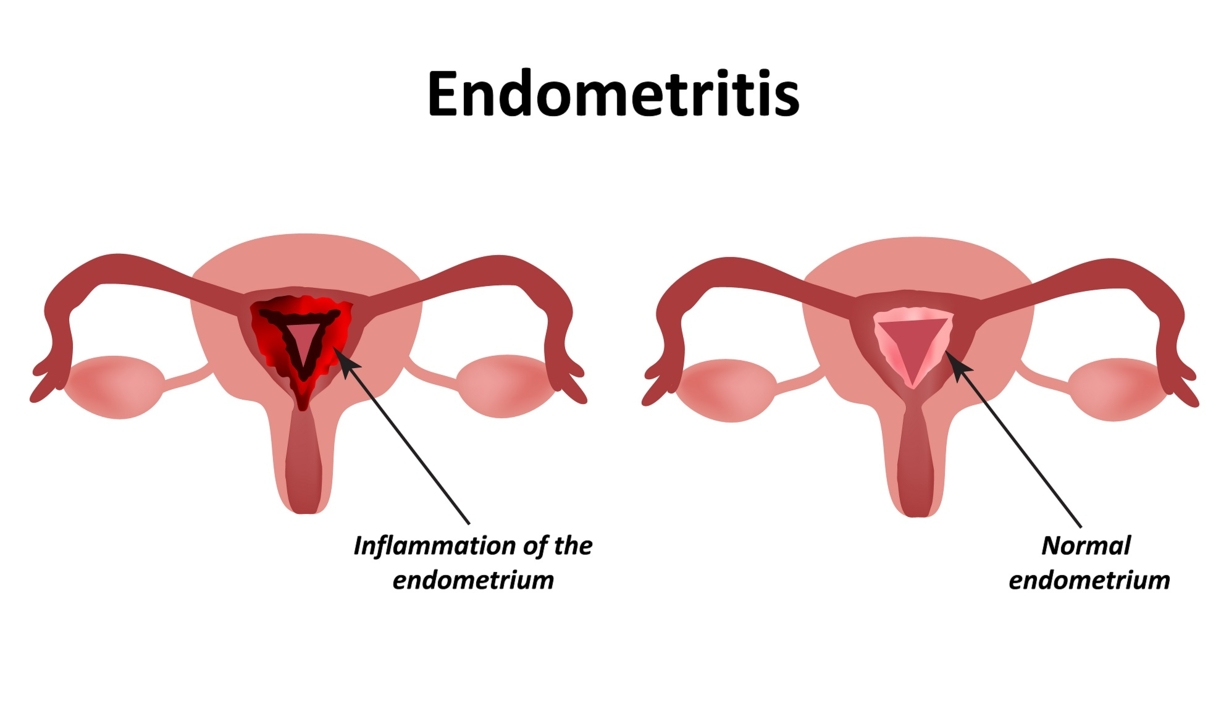 endomteritis treatment endomteritis teatment