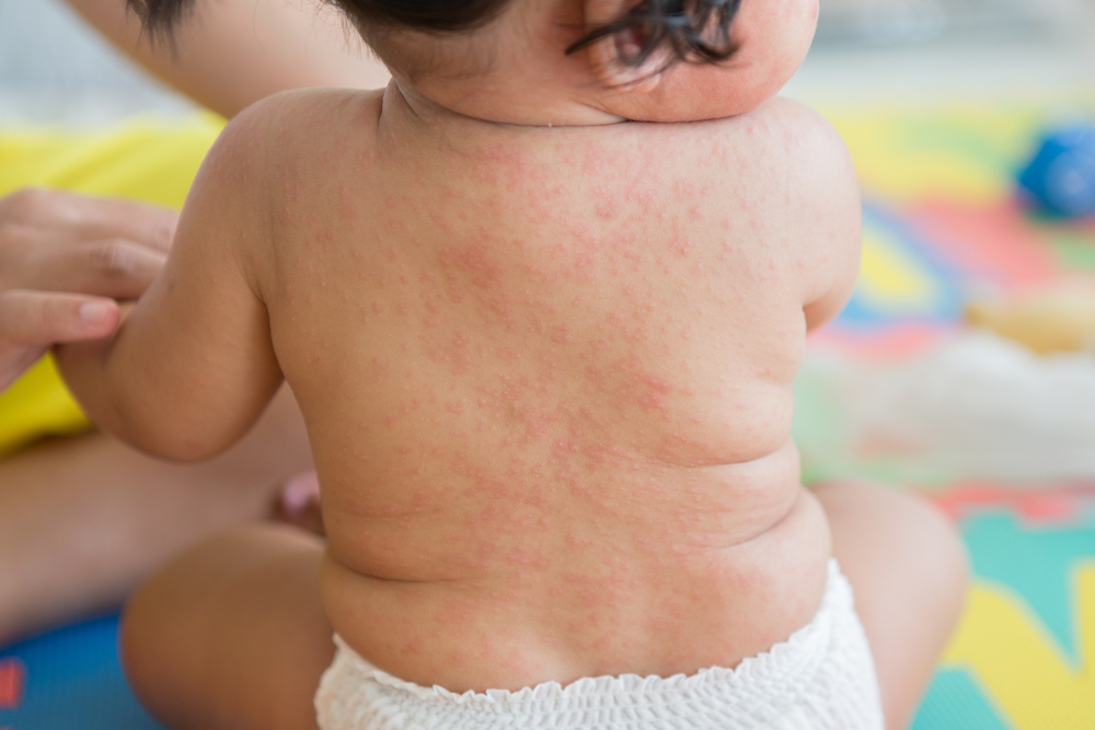 Rubella symptoms Rubella symptoms