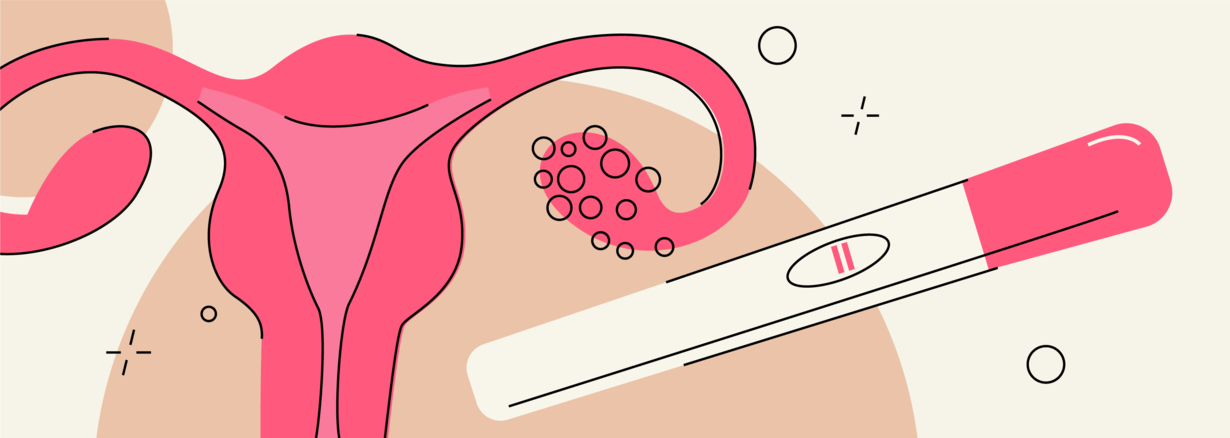 Getting Pregnant With Pcos Everything You Need To Know