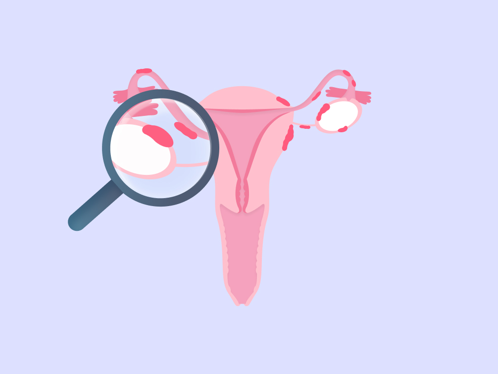 Endometriosis: What causes it, how it's diagnosed and treated - Flo