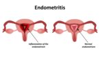 endomteritis teatment