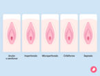 Diferentes tipos de himen y su aspecto