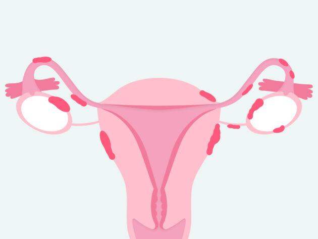 endometriosis surgery