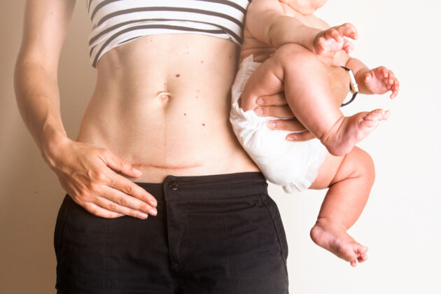 woman with a baby showing her scar after a c-section delivery woman with a baby showing her scar after a c-section delivery
