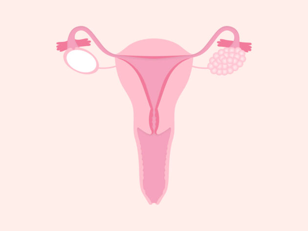 Ovarian cancer bloating Ovarian cancer bloating