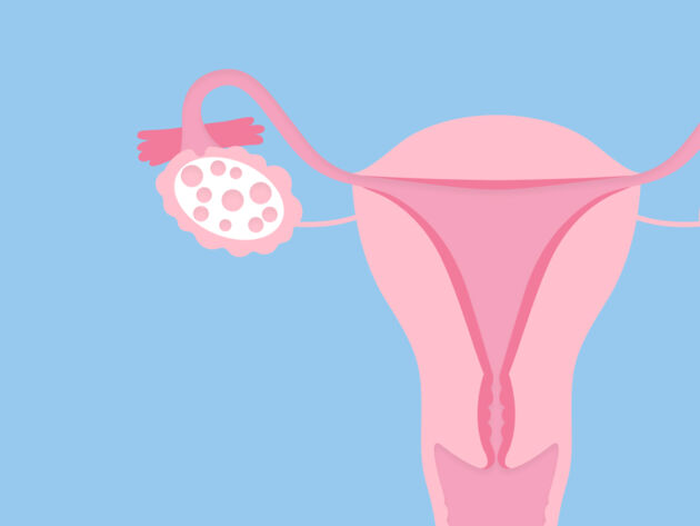 PCOS treatment PCOS treatment