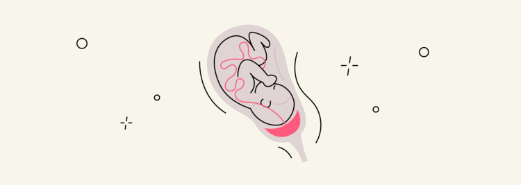 Placenta Previa: Root Causes, Symptoms, and Treatments