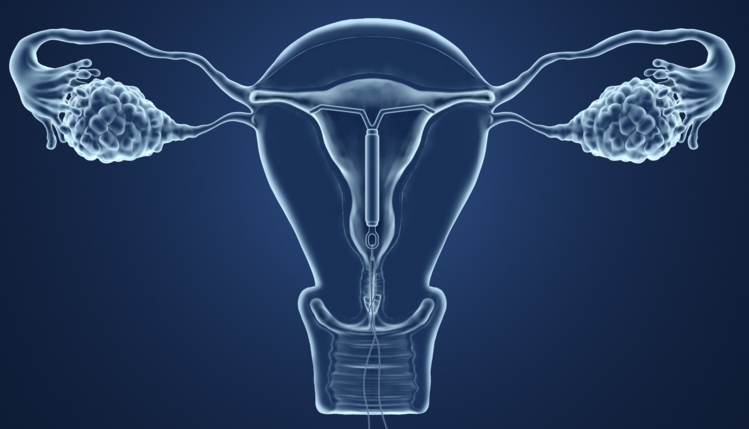5 cosas que deberías saber si estás pensando en el DIU después del parto